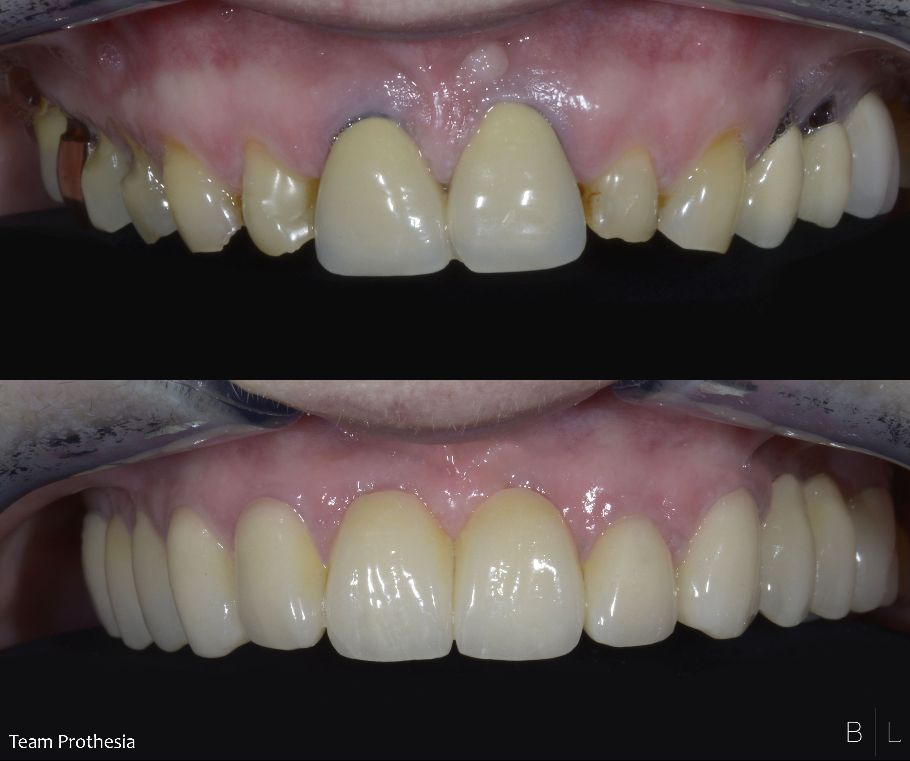 3-dentiste-antibes-changement-couronnes